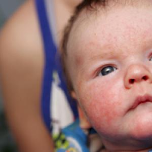 Как выглядит аллергия у новорожденных